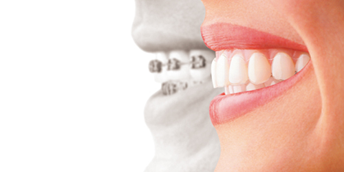 矯正治療の説明