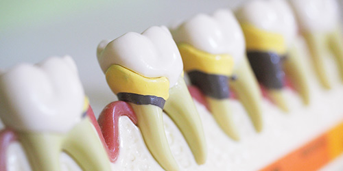 歯周病治療の説明を行うための模型