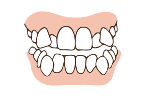 歯並びが悪いイラスト