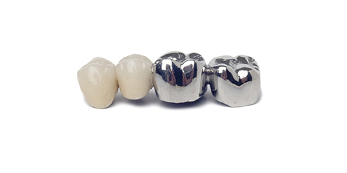 永沢デンタルクリニックの歯が抜けた場合の治療の説明(ブリッジ)