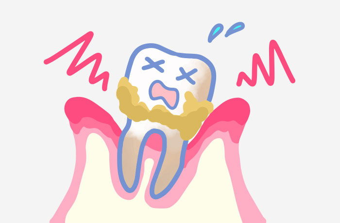 むし歯のイラスト