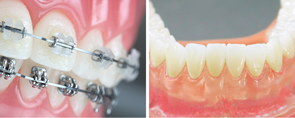 永沢デンタルクリニックの歯並び治療法