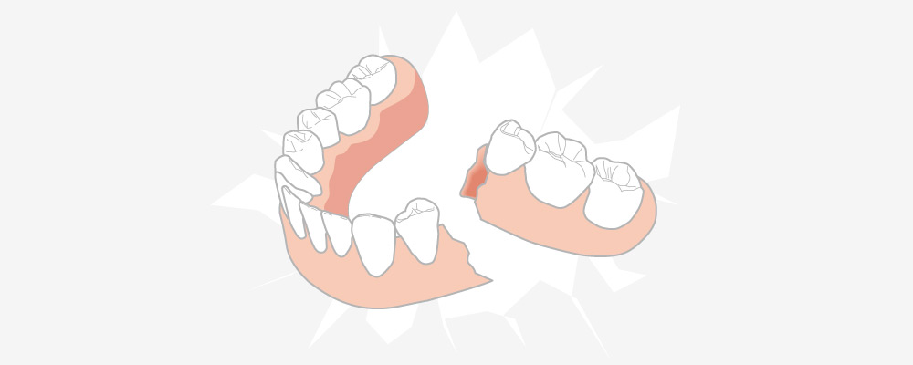 永沢デンタルクリニックの入れ歯が壊れた場合の対処法解説