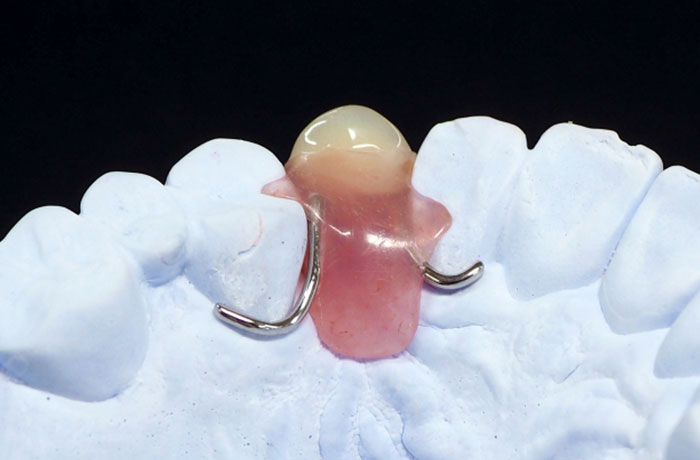 部分入れ歯の画像