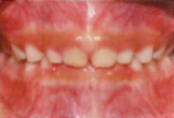 良くない歯並びの例：ディープバイト（写真）