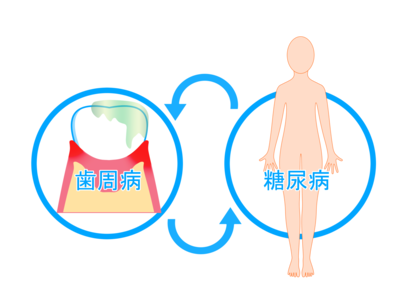歯周病と糖尿病イメージ